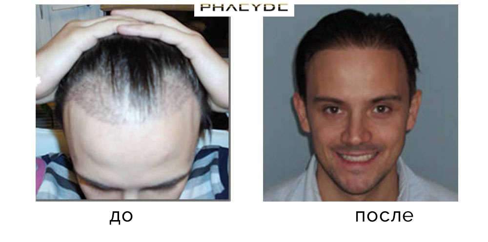 Трансплантация волос Miklos S. 5000 волосы