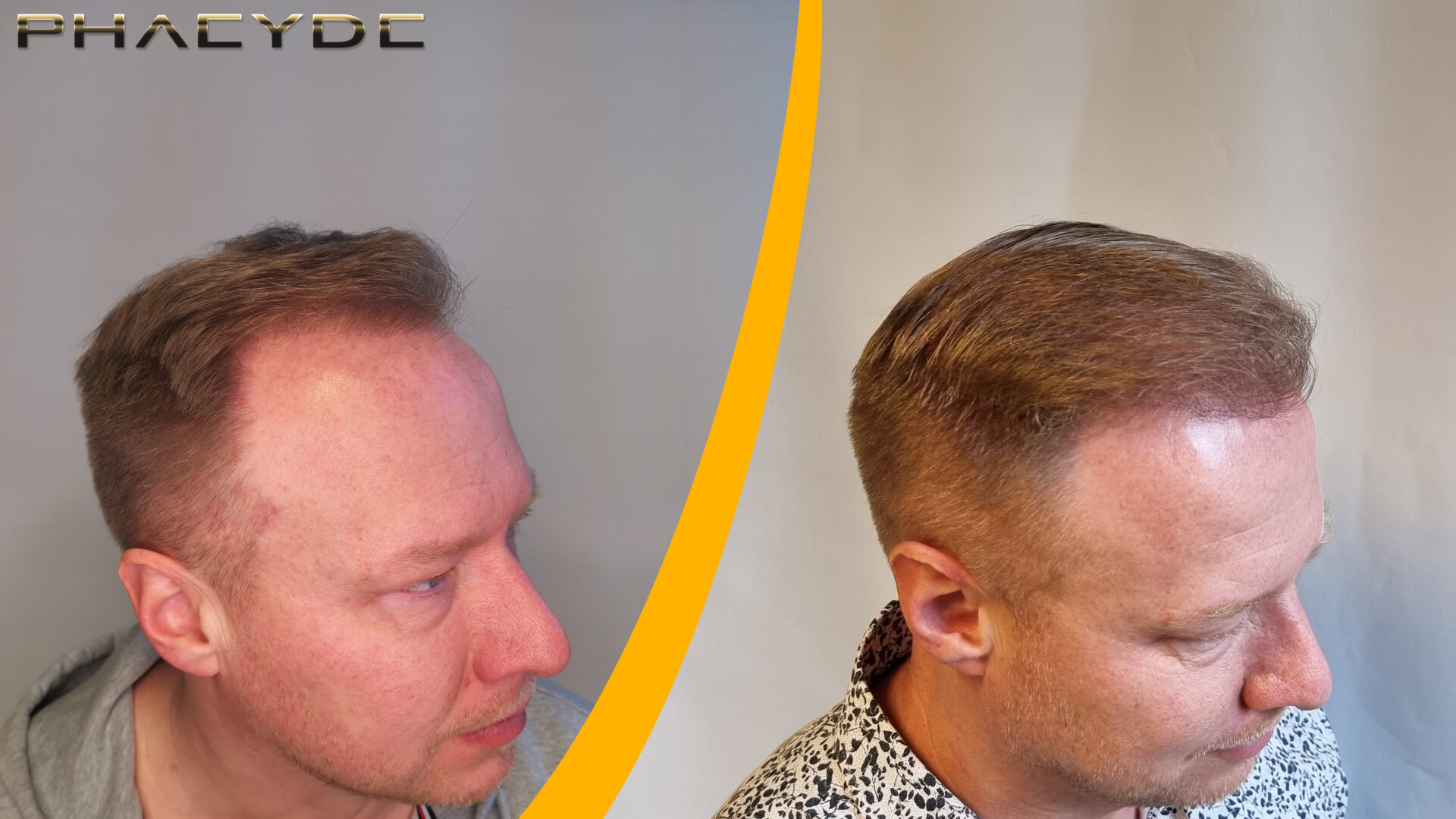 Vor und nach der Haartransplantation - 1600 Grafts