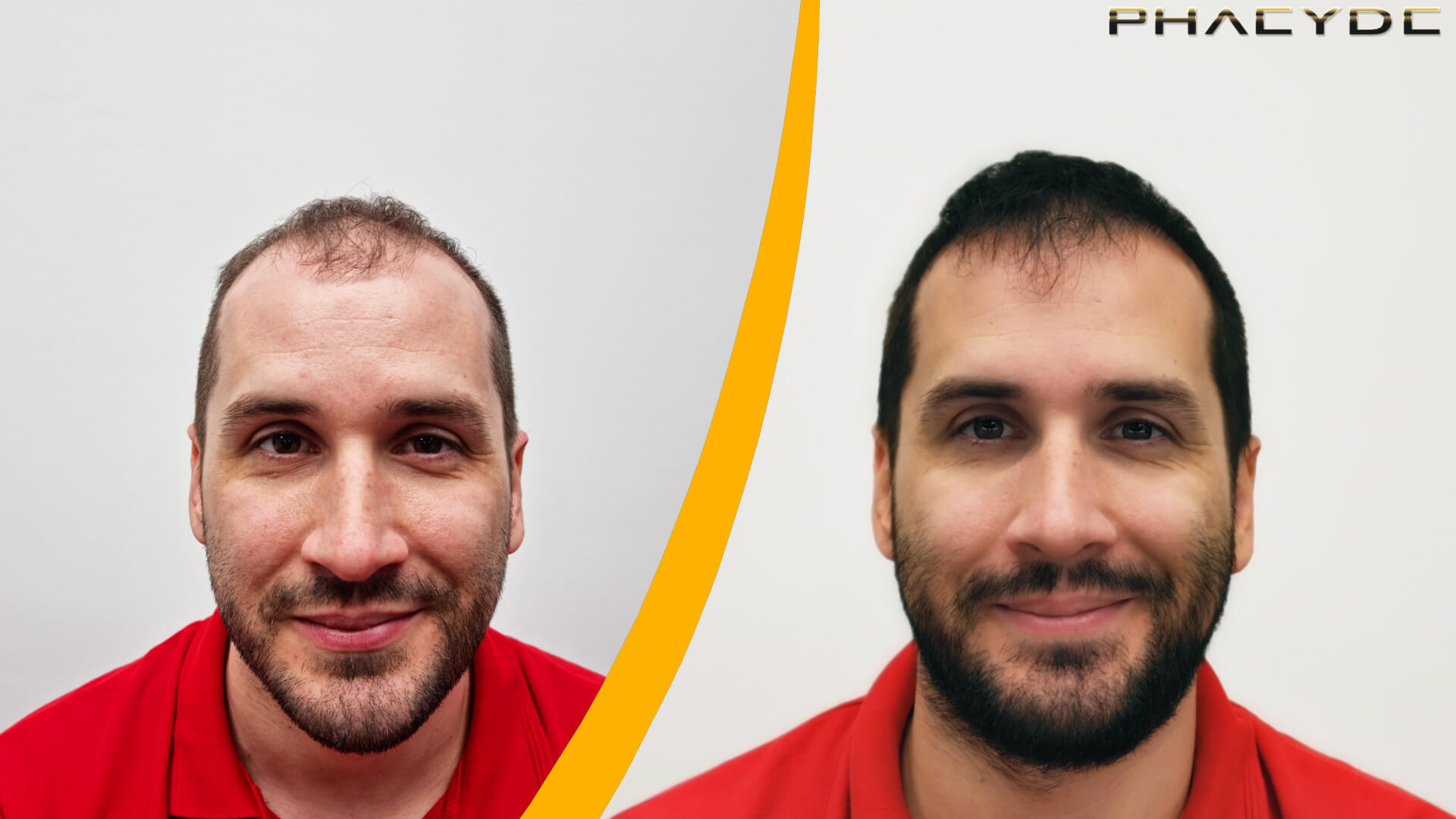 Haartransplantation Vorher & Nachher Ergebnis