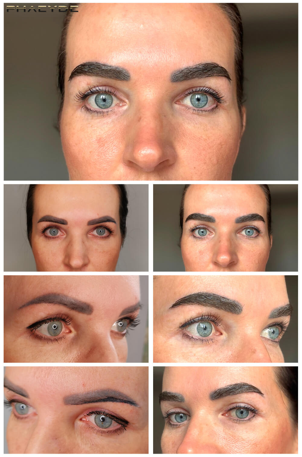 Augenbrauen Transplantation