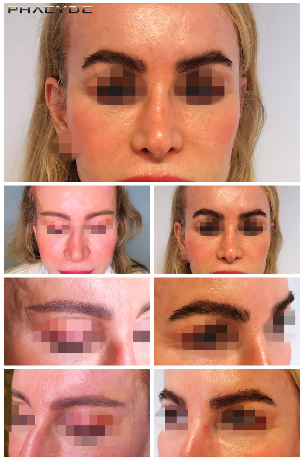 Augenbrauen Transplantation