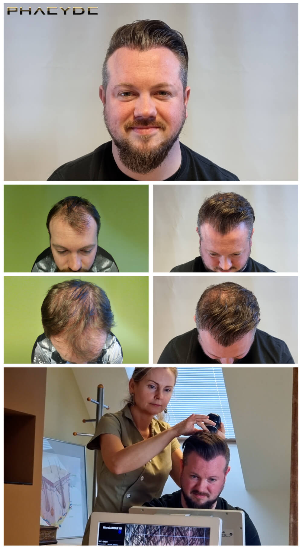 i/hair-transplantation/before-after-photos/hair-transplant-before-after-christoph-phaeyde-clinic.jpg