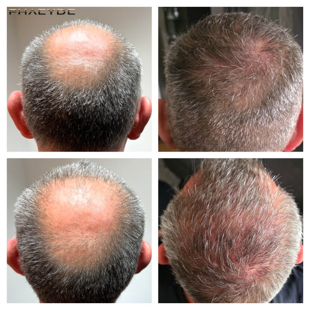 Markus – 2800+ Grafts